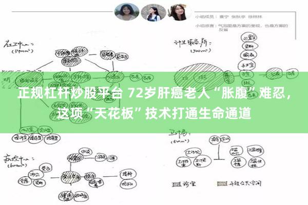 正规杠杆炒股平台 72岁肝癌老人“胀腹”难忍,这项“天花板”技术打通生命通道